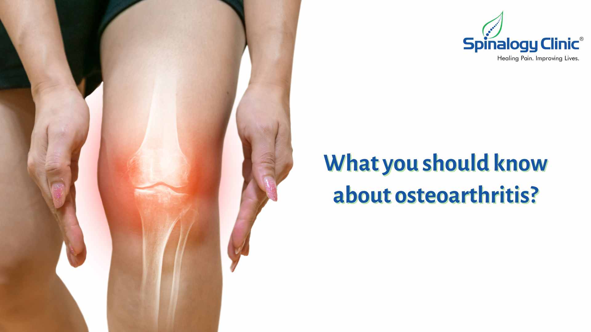 What You Should Know About Osteoarthritis?